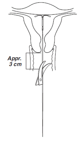 Cutting the threads - Illustration Cutting the threads - Illustration