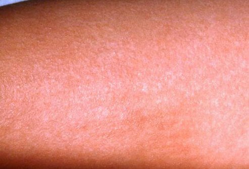 If your sore throat is associated with a fine, sandpaper-like pink rash on the skin, it could be scarlet fever.