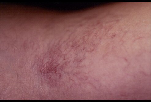 Picture of Spider Veins