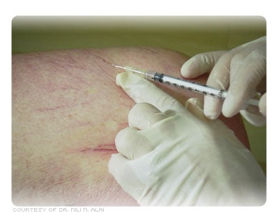Picture of Spider Veins Being Treated with Sclerotherapy