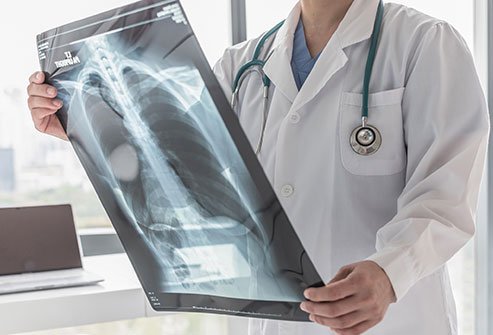 COPD X-Ray
