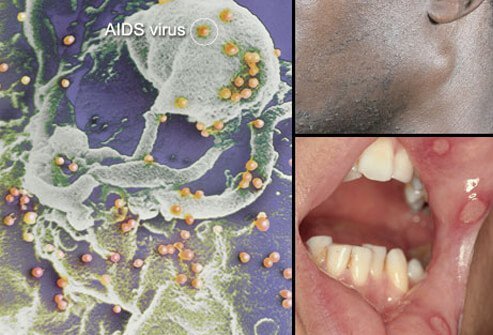 The HIV virus (AIDS virus) weakens the body's immune system.