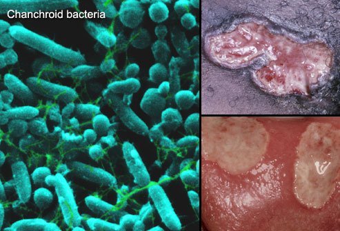 Chancroid is more common in Africa and Asia.