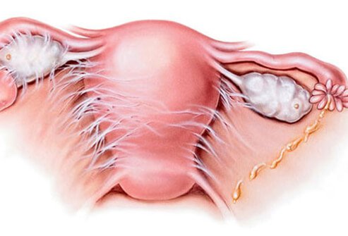 In PID, bacteria spread to the uterus and female reproductive tract.