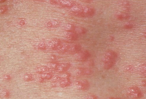 Scabies is often spread during sexual contact.
