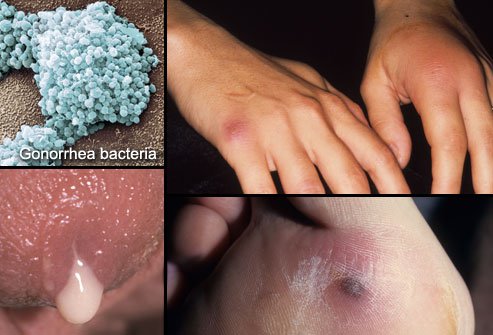 Gonorrhea is easily transmitted.