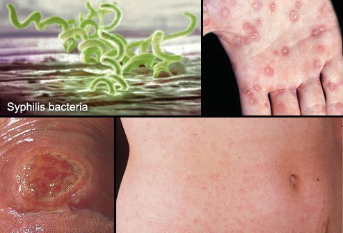 Syphilis can be cured with antibiotics.