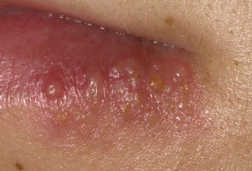 Oral herpes is usually not considered a sexually transmitted disease.