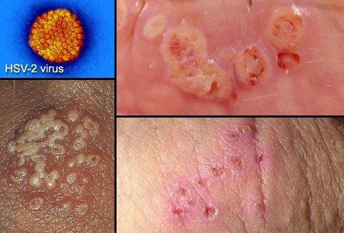 As with oral herpes, medications can reduce the severity of genital herpes, but there is no cure.