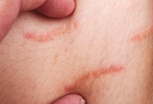 When elastic fibers in your skin tear it creates stretch marks. 