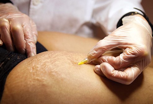 See a dermatologist for professional assistance dealing with stretch marks and other skin conditions.