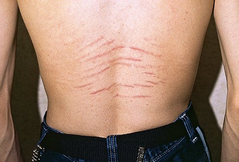 Many women get stretch marks but men can get them, too. 