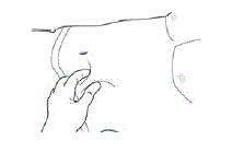 Insert needle fully into the abdominal subcutaneous
tissue - Illustration Insert needle fully into the abdominal subcutaneous
tissue - Illustration