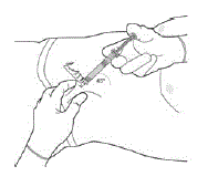 Withdraw the needle at the same angle used for insertion
and release the pinched skin - Illustration Withdraw the needle at the same angle used for insertion
and release the pinched skin - Illustration