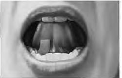 Place the SUBOXONE sublingual film under your tongue, close to the base either to the left or right of the center - Illustration