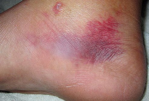 Stingray stings may produce sharp pain and bleeding.