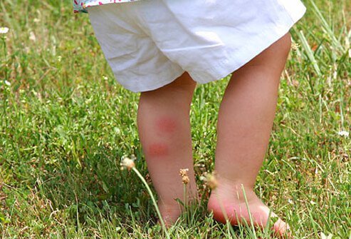 Chigger bites produce red, itchy welts on the skin.