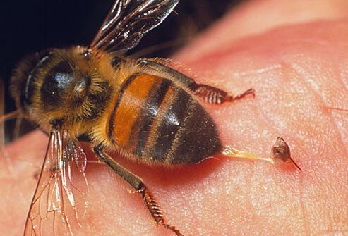 Bee sting reactions may range from mild to potentially life-threatening.