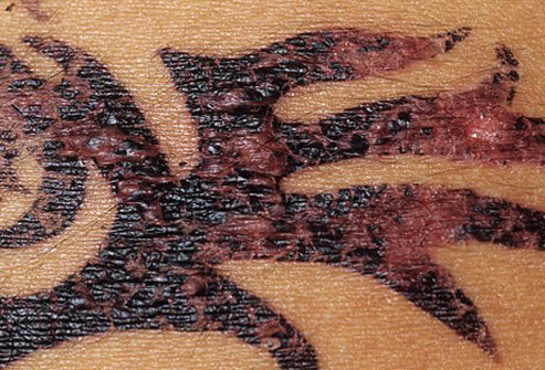 People complain to the FDA that they experience skin irritation or even allergic reactions to temporary henna tattoos.