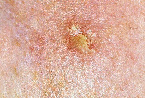 Actinic keratosis is the name for small, scaly red or brown papules that are the result of excessive sun exposure.