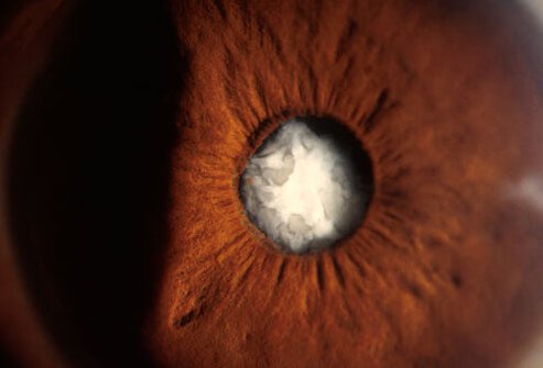 The lens of the eye can develop a cataract due to overexposure from ultraviolet (UV) light from the sun.
