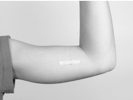 Close the incision using adhesive strips - Illustration