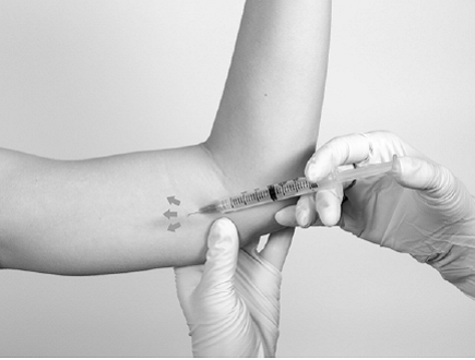 Inject anesthetic into the subcutaneous tissue - Illustration