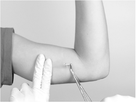 Grasp the implant with the sterile mosquito clamp - Illustration