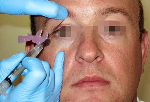 A supraorbital nerve block is a procedure to provide regional anesthesia to the area of the face from the upper eyelid to the top of the head. A supraorbital nerve block is a procedure to provide regional anesthesia to the area of the face from the upper eyelid to the top of the head.