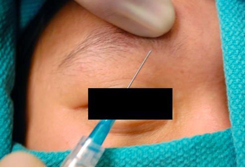 A supratrochlear nerve block in an injection of anesthetic below the eyebrow to numb the face.