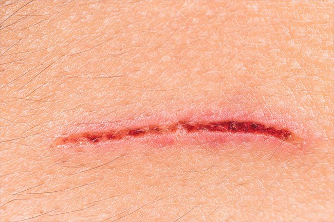 Slow healing wounds may be a sign of immune system dysfunction.