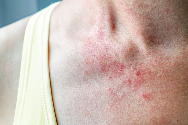 Eczema is an allergic skin rash and a sign of an overactive immune system. 