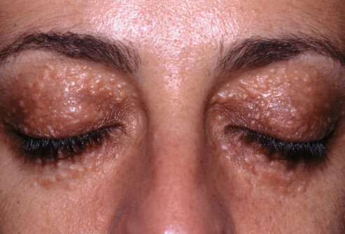 Syringomas