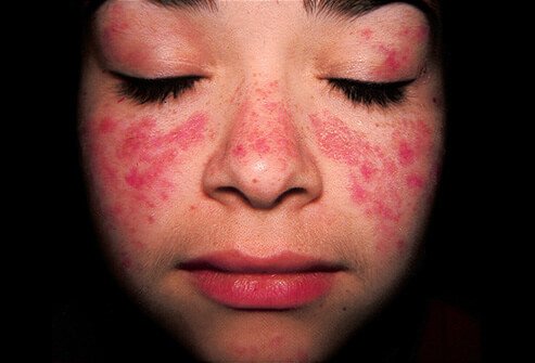 A butterfly rash is a sign of lupus.