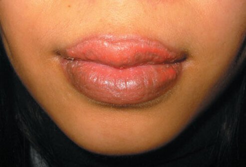 Allergic hypersensitivity to cosmetic tattoo on lips.
