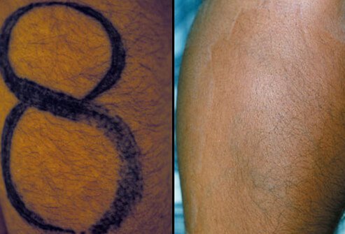Tattoo on forearm before and after removal therapy.