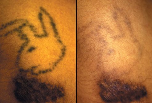 Dermabrasion and laser tattoo removal.
