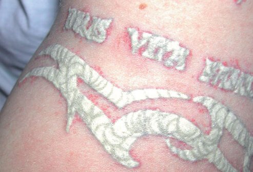 Tissue whitening after laser tattoo removal.