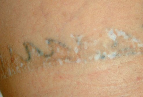 Scar after treatment with Q-switched ruby laser.