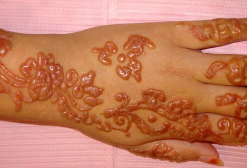 Tense Bullae of infected henna tattoo.