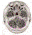 Example of Cerebellar Region of Interest - Illustration Example of Cerebellar Region of Interest - Illustration