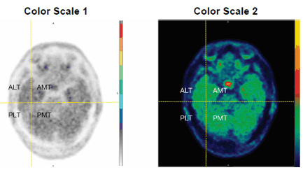 Temporal Lobe Quadrants - Illustration Temporal Lobe Quadrants - Illustration