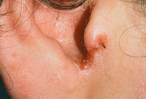 Photo of swimmers ear.