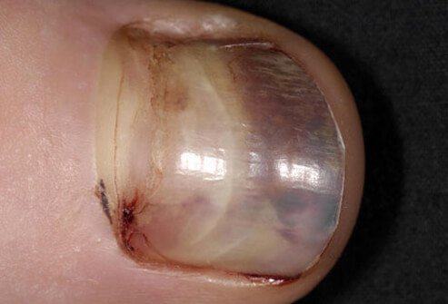 Photo of runner's black toenail.