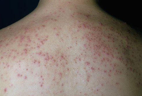 Photo of heat rash.