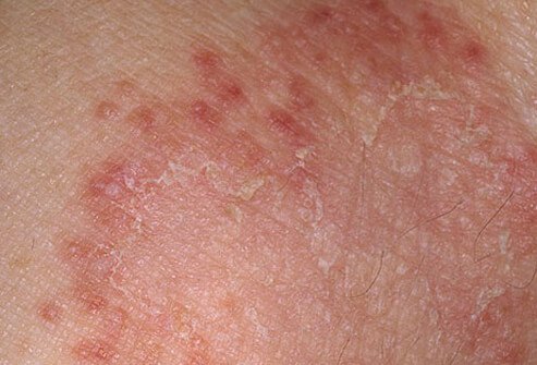 Photo of ringworm.