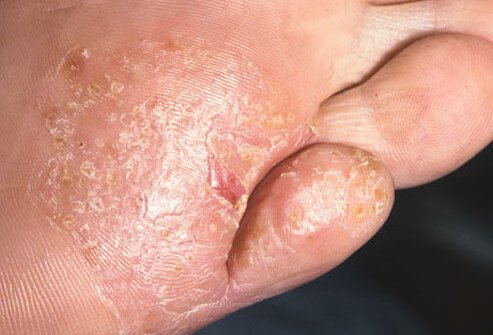Photo of athlete's foot.