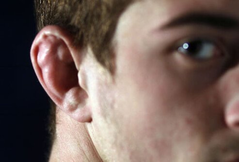 Photo of boy with cauliflower ear.