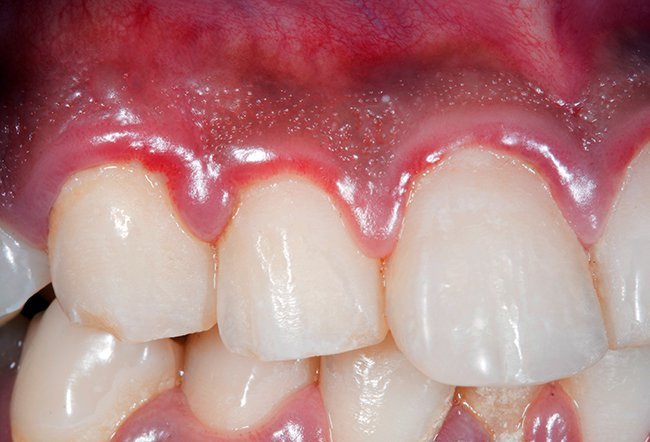 gums are black