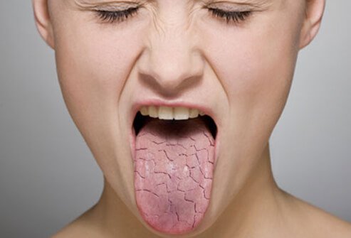 A woman with a dry mouth. 